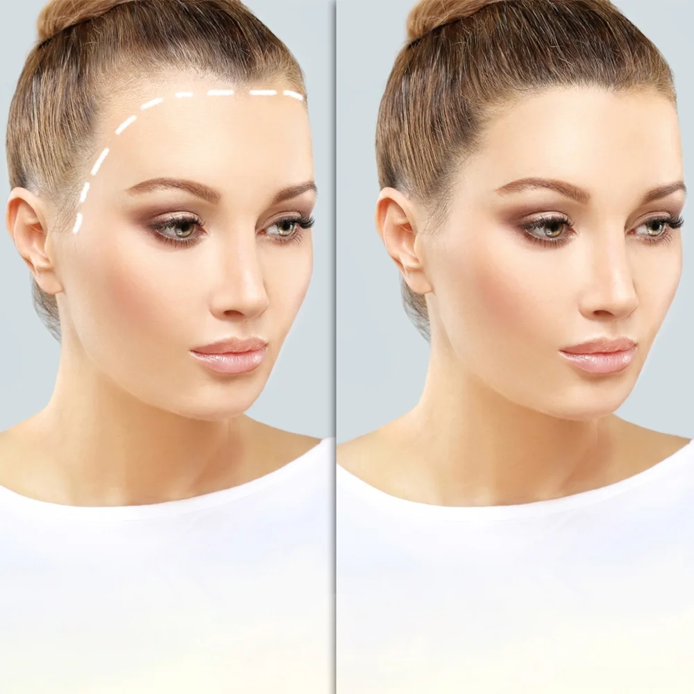 Hair transplant uk